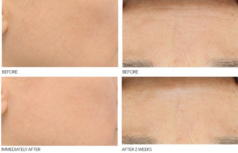 Dr Dennis Gross Professional Grade Resurfacing Liquid Peel результаты